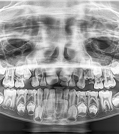 Panoramic dental Xray of a child